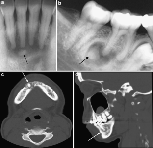Cemento-osseous dysplasia, a radiological mimic of periapical dental ...