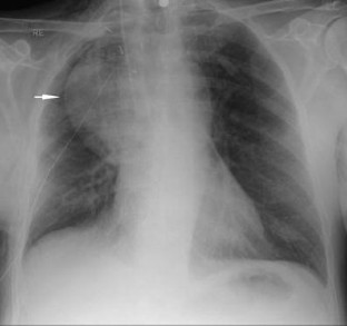 Right middle lobe torsion: evaluation with CT angiography | SpringerLink