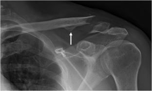 Recover from broken clavicle picture