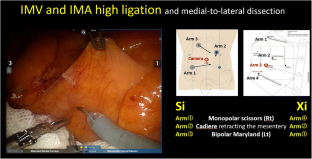 Robotic low anterior resection: how to maximise success in ...