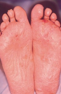 Necrolytic Migratory Erythema: Case Report and Clinical Review ...