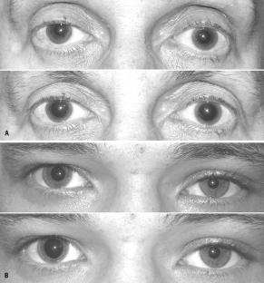 pupillary reaction test pupillary reaction test
