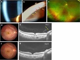 Vitreous anatomy and the vitreomacular correlation | SpringerLink
