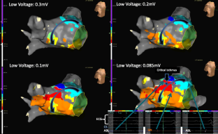 ra ablation for atrial flutter icd 10 pcs ra ablation for atrial flutter icd 10 pcs