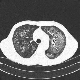boop pneumonia survival rate boop pneumonia survival rate