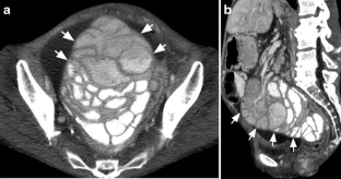 Abdominal Cocoon Syndrome: A Rare Cause For Recurrent Abdominal Pain 