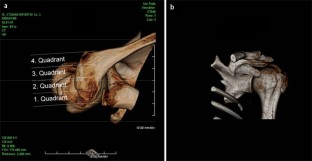 Tendinosis calcarea der Schulter | SpringerLink