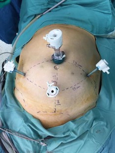 The Senhance™ surgical robotic system (“Senhance”) for total