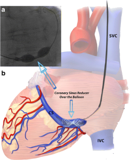 Dr Oz Cara Mengatasi Sinusitis 3319 Part 1 Youtube Dr Oz Cara Mengatasi Sinusitis 3319 Part 1 Youtube