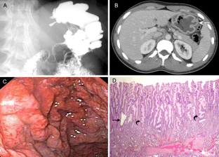 Menetrier disease essays 07 image
