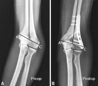 Oblique Closing Wedge Osteotomy and Lateral Plating for Cubitus Varus ...