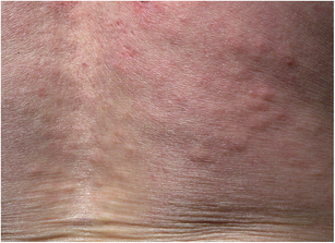 pinpoint red dots on skin lupus pinpoint red dots on skin lupus