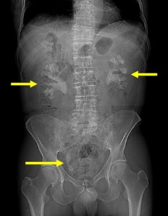 Infection-Related Kidney Stones | SpringerLink