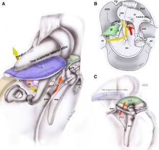 Endoscopic Anatomy of the Middle Ear | SpringerLink