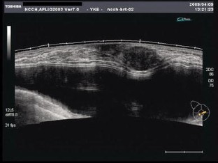 breast ectomy with sentinel node biopsy breast ectomy with sentinel node biopsy