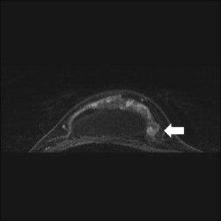 breast ectomy with sentinel node biopsy breast ectomy with sentinel node biopsy