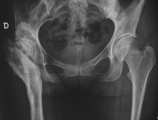 Total hip replacement fifteen years after pelvic support osteotomy (PSO ...