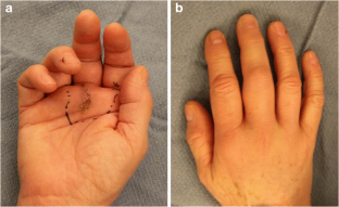 pulley a1 trigger finger tenosynovitis release fig complicated flexor