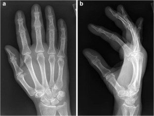 pulley finger fig tenosynovitis flexor trigger complicated a1 release