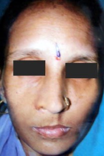 Ileus feeding tube picture