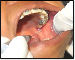 Comparison of Clinical Efficacy of Classical Inferior Alveolar Nerve