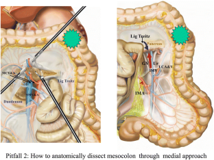 hepatic flexture resection hepatic flexture resection