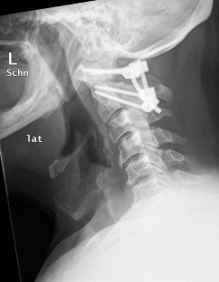 Verletzungen der oberen Halswirbelsäule | SpringerLink