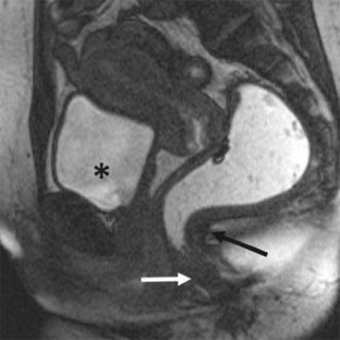 Magnetic Resonance Imaging of Female Pelvic Floor Dysfunction: A Review ...