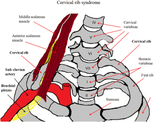 Thoracic outlet syndrome: a rare case with bilateral cervical ribs and ...