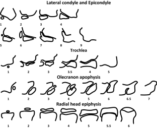 bone age and chronological age bone age and chronological age