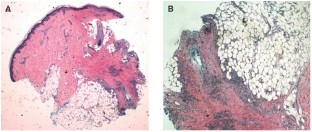 A case of fistulizing Crohn's disease and erythema nodosum managed with ...