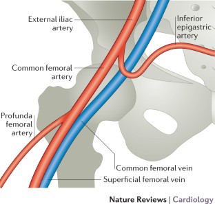 Arterial access and arteriotomy site closure devices | Nature Reviews ...