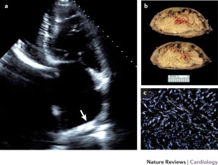 Pathology, imaging, and treatment of cardiac tumours