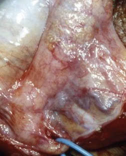 Current status of vasectomy reversal | Nature Reviews Urology