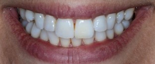 The single discoloured tooth: vital and non-vital bleaching techniques ...