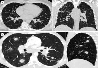 Sarcoidosis | Nature Reviews Disease Primers