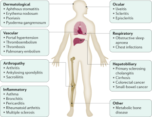 Crohn’s disease | Nature Reviews Disease Primers