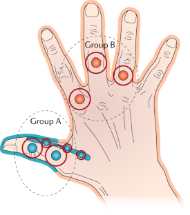 Pathophysiology, Assessment And Treatment Of Psoriatic Dactylitis ...