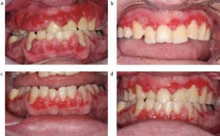 gingival overgrowth gingival overgrowth