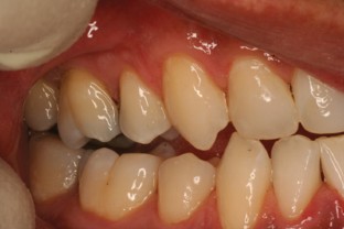 The management of cracked tooth syndrome in dental practice | British ...