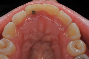 gingival overgrowth gingival overgrowth