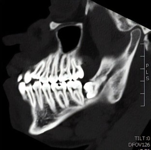 Coronectomies: assessment and treatment planning | British Dental Journal