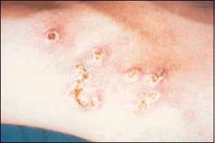Diagnosis and Treatment of Scabies | SpringerLink
