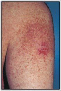 Darier’s Disease | SpringerLink