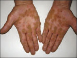 Punctate Palmoplantar Keratoderma SpringerLink punctate-palmoplantar-keratoderma-springerlink