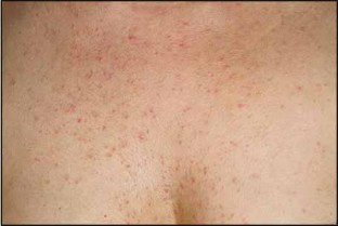 Immunologically Mediated Photodermatoses | SpringerLink