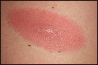 Skin Manifestations of Lyme Borreliosis | SpringerLink
