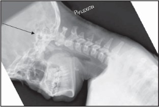 Cervical Spine Injuries In American Football | SpringerLink