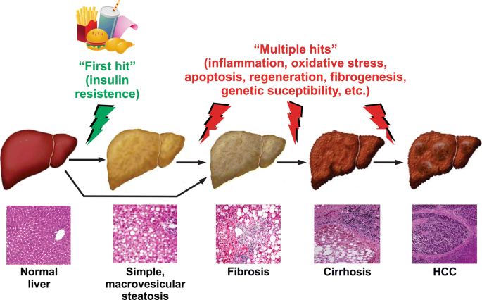 Molecular pathways of nonalcoholic fatty liver disease development and  progression | Cellular and Molecular Life Sciences | Springer Nature Link