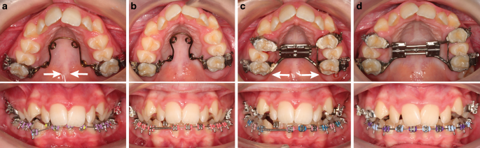 Quad-helix compression to decompensate molar inclination prior to skeletal  expansion | Journal of Orofacial Orthopedics / Fortschritte der  Kieferorthopädie